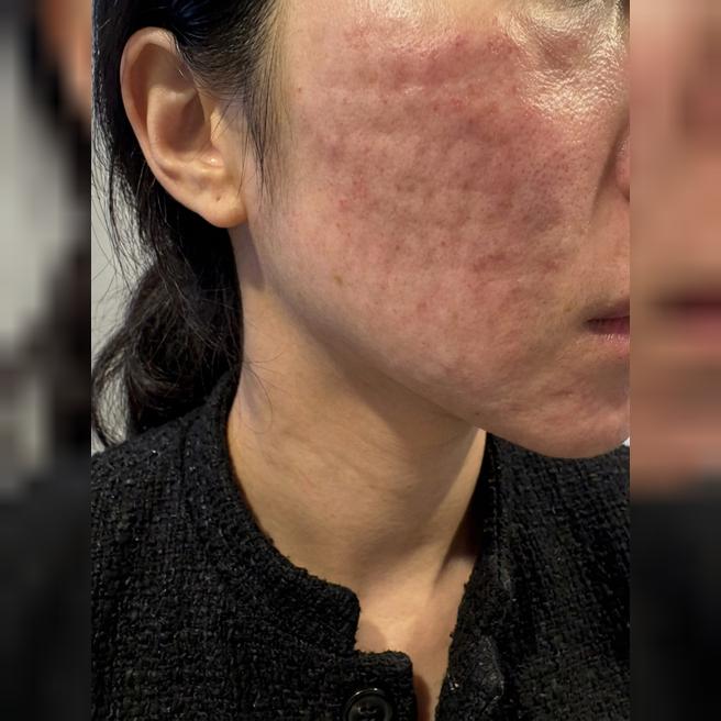리쥬란 1년 넘게 받는데 속건조 해결되고 피부 탱글해져요 ㅎㅎ