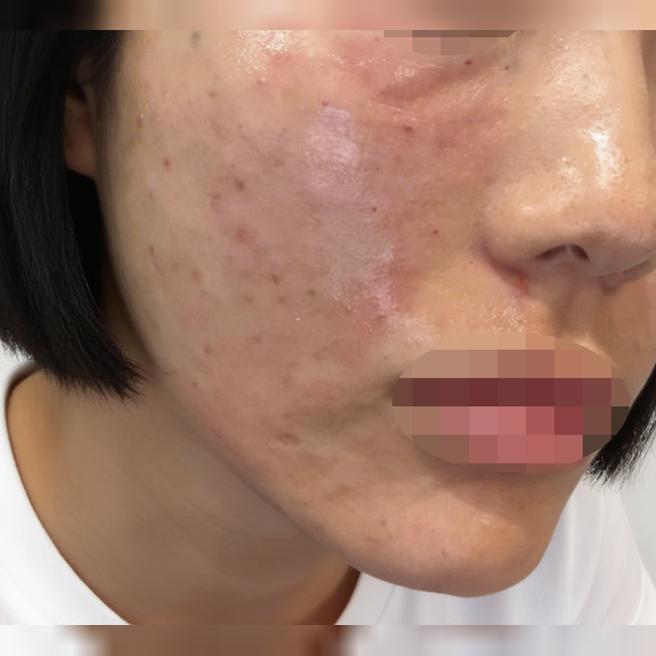 예민한 피부인데 리쥬란 받고 진정되는 느낌이에요~ 일부러 강남역에서 가까운 곳 오길 잘한 것 같아요!