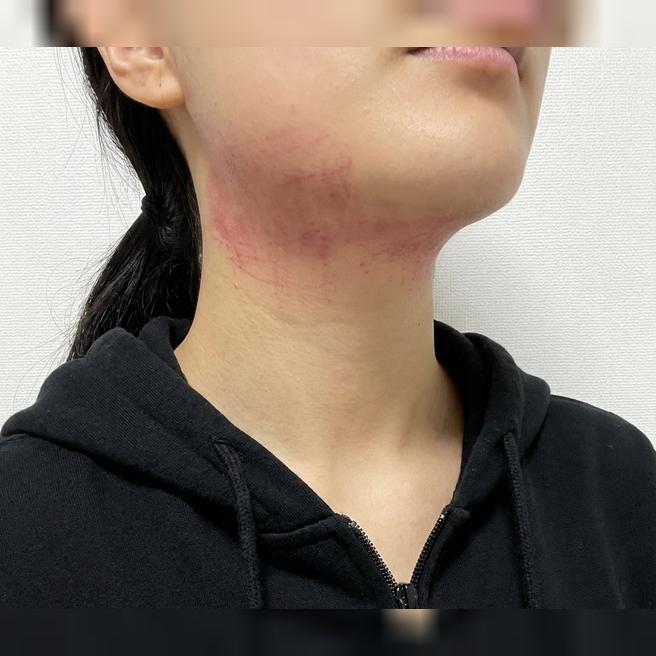 두둑한 얼굴 고민으로  방문했는데 친절한 응대에 꼼꼼한 케어까지, 인모드 받길 잘했어요! 