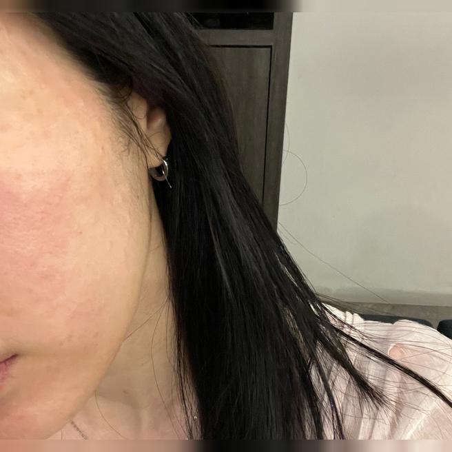 평소 궁금했던 리쥬란, 수분 부족해서 드디어 받아봤어요~ㅎㅎ