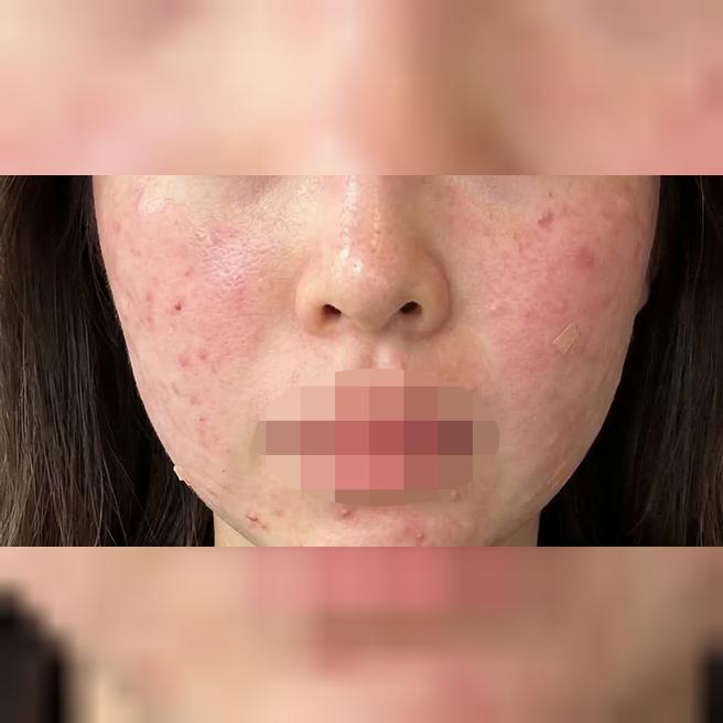 리쥬란 받았는데 만족이라 다른 시술도 해보려고요!