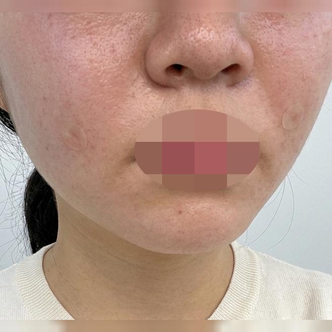 팔자주름 신경 쓰여서 방문, 레이어스 콜라겐부스터로 결정했어요!