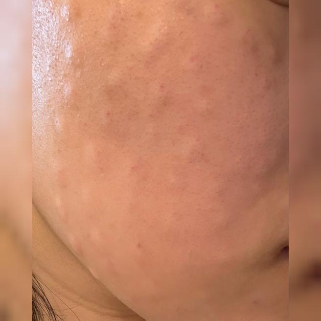 한 번 맞고 반해서 2달 만에 다시 예약했어용~~서울아이 리쥬란 찐후기
