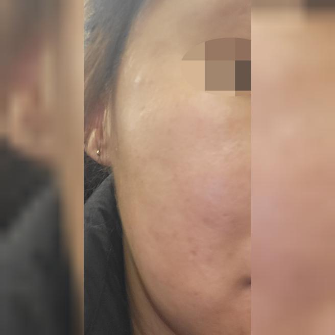 모공 고민으로 받았는데 3개월치 추가 결제하고 왔어요 ㅎㅎ
