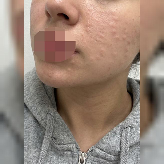 과한 업셀링 없어서 편하게 받은 리쥬란 후기예요~