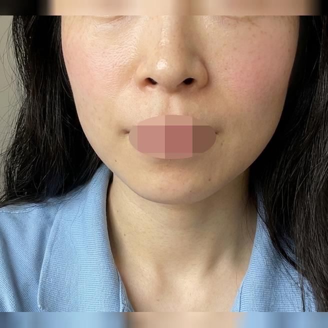 피부톤 개선이랑 잡티 잡으려고 토닝 받으러 방문했어요!