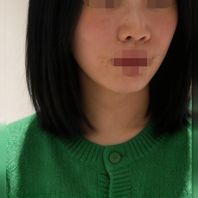 모공 고민으로 왔는데 수면으로 편하게 받고 대기도 짧았고, 일본 통역 덕분에 편했습니다~