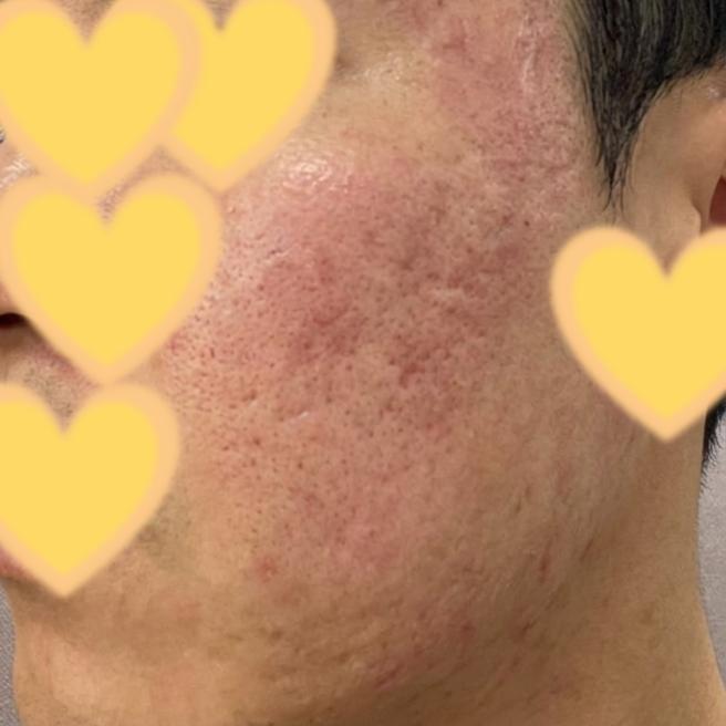 리쥬란 받자마자 셀카 찍어봤습니다, 남자 당일 후기