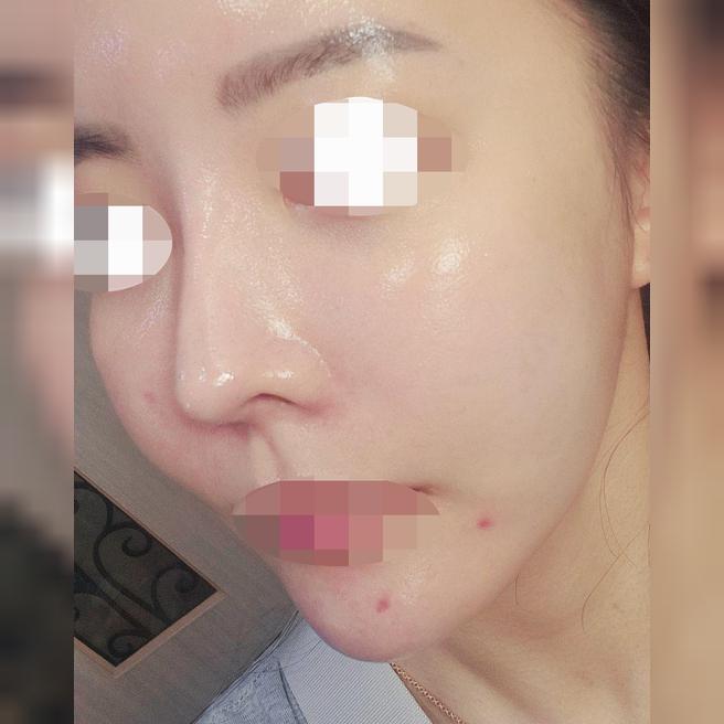눈가 건조함이랑 피부결 고민으로 방문해서 시술로 한번에 해결했어요~ㅎㅎ