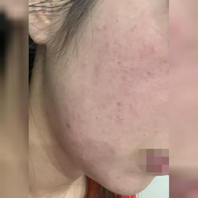 써마지 받아봤는데 빠른 응대에 친절한 직원분들까지 만족이에요~