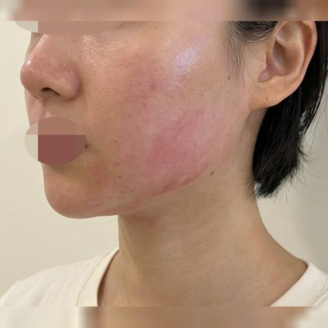 리프팅 고민으로 온다리프팅 수면으로 받으러 방문했어요!