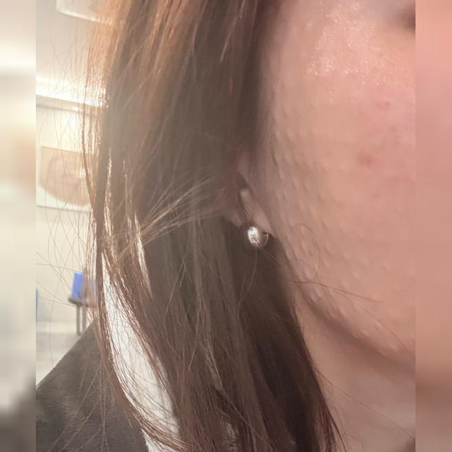 리쥬란 받았는데 엠보 촘촘하게 잘 올라와서 만족이에요 ㅎㅎ