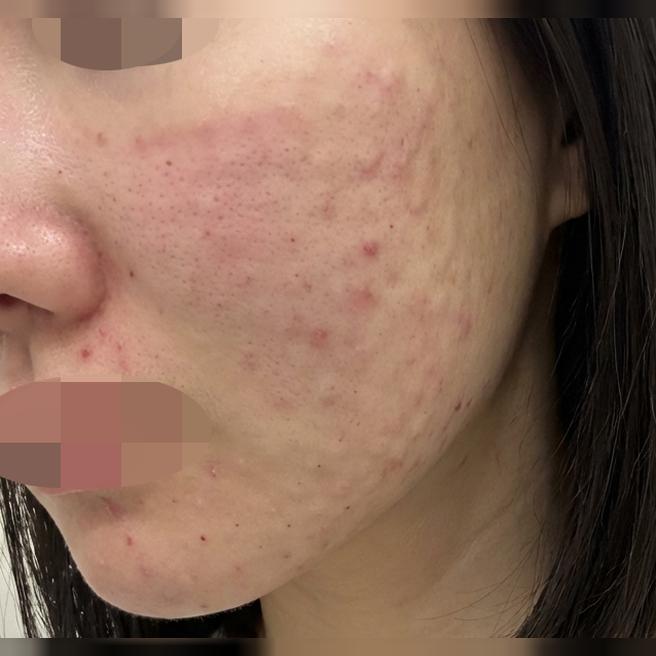 팔자주름 고민으로 왔는데 자연스럽게 채워져서 만족이에요!