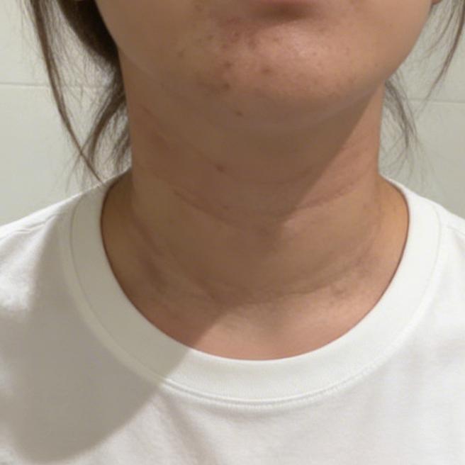 나이 먹을수록 목주름 신경쓰여서 시술 받으러 왔어요~!