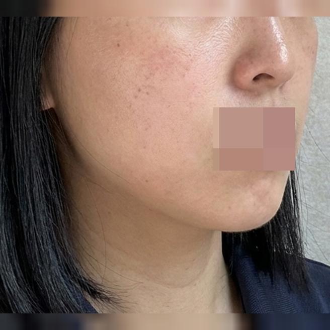 2일 차부터 잔주름 잡힌 게 보여요! 쥬베룩 대만족이에요