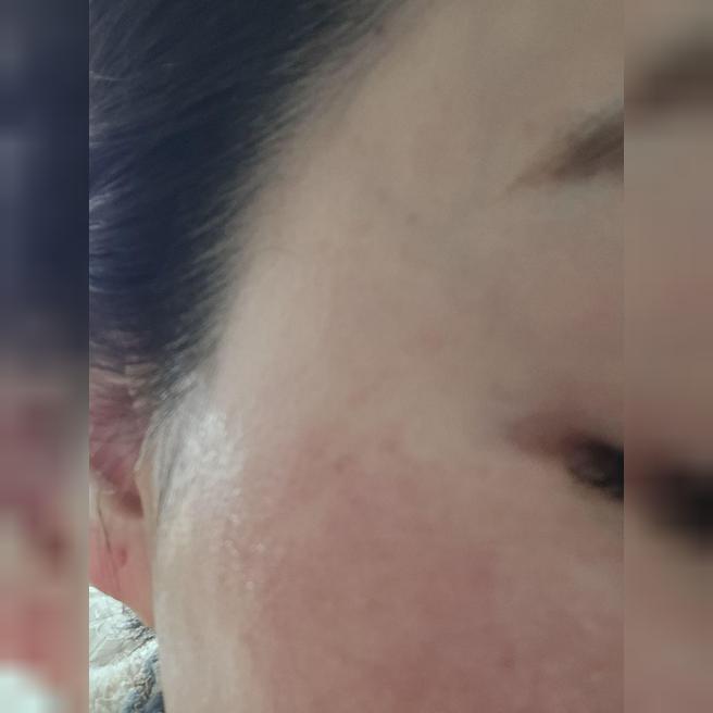 수면으로 통증 없이 받은 포텐자, 일주일 뒤 결과가 기대돼요~!