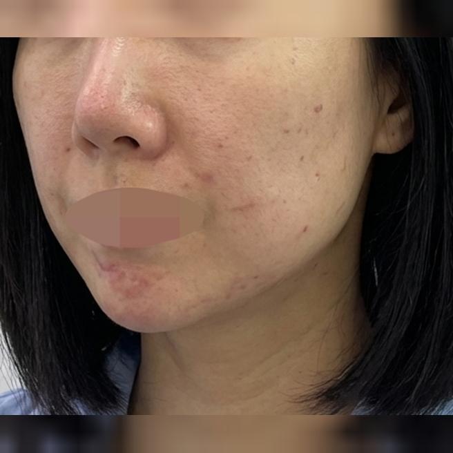 수면으로 스킨보톡스+인모드 한번에 챙기려고 방문했어요