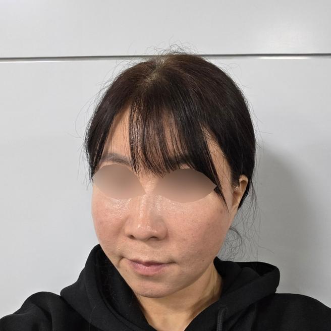 리쥬란 5일차, 눈밑이랑 볼 푸석함 달라지는 중