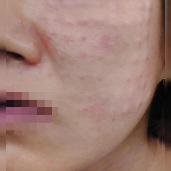 엠보 촘촘하게 잘 올라와서 앞으로 더 예뻐질 피부가 기대돼요ㅎㅎ