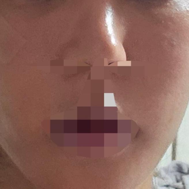 피부결과 모공 고민으로 리쥬란 받았어요