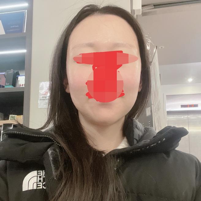 리쥬란 받았는데 바로 촉촉해져서 만족이에요ㅎㅎ!!
