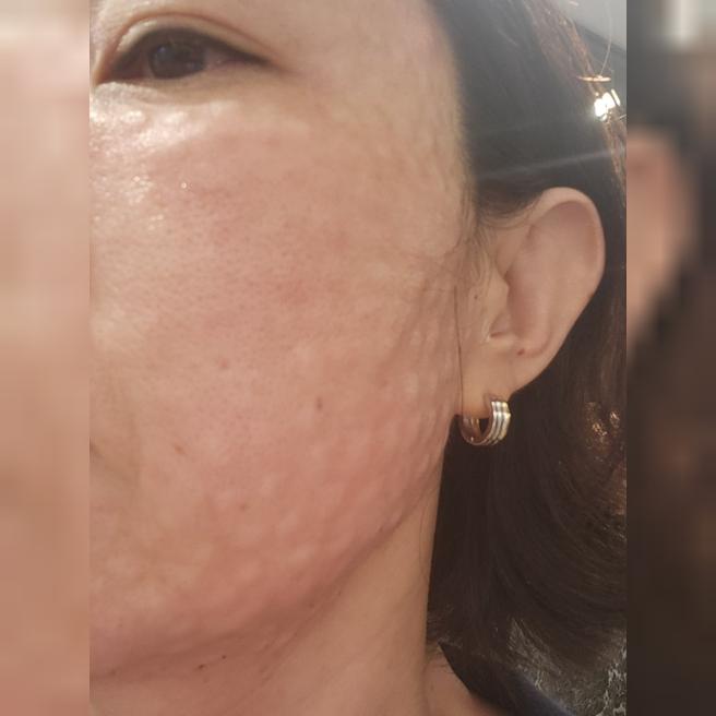 2회차 리쥬란, 꼼꼼한 엠보에 친절한 응대까지 만족이에요!!