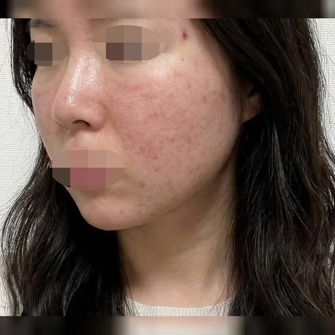 효과 좋아서 재방문했는데 상담부터 시술까지 꼼꼼한 것 같아요 ㅎㅎ