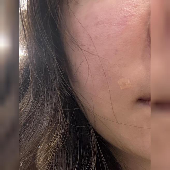 수면으로 진행해서 시술 내내 편하게 받을 수 있었어요ㅎㅎ