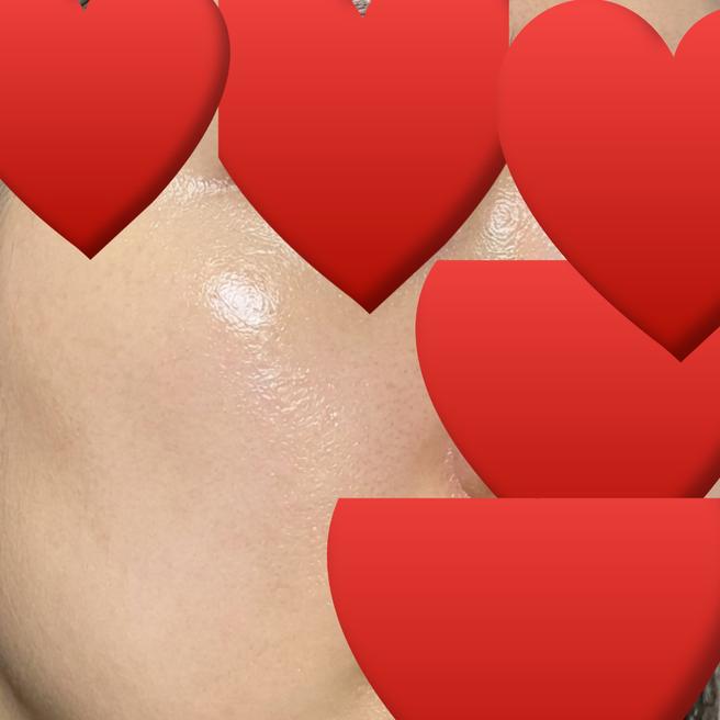 써마지 1주차, 피부가 탄탄해진 느낌이에요