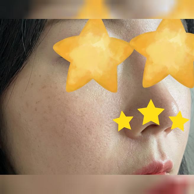 한달전에 리쥬란 맞았는데 슬슬 효과 느껴지는 것 같아요!