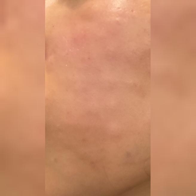속건조 너무 심해서 리쥬란 수면으로 받아봤어요~