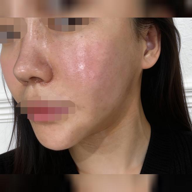 온다리프팅 좋다고 해서 왔는데 과한 권유 없이 편하게 받았어요 ㅎㅎ