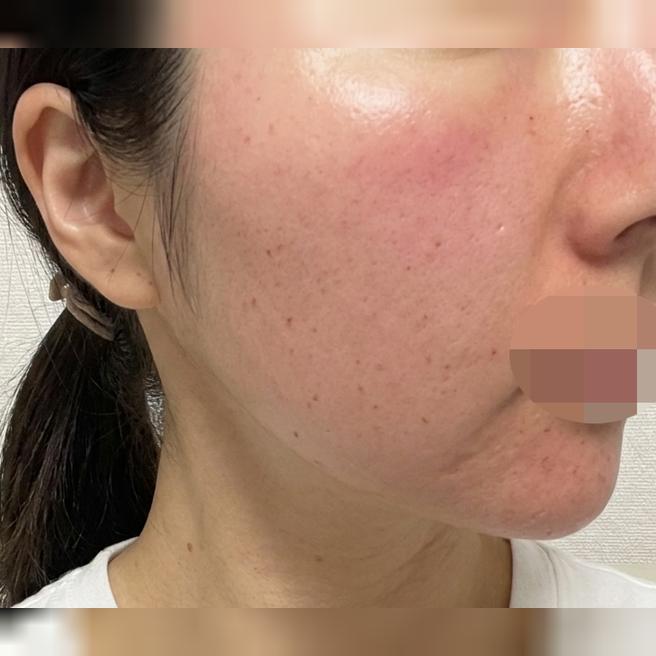 모공이랑 속건조 케어 위해 두 시술 한 번에! 만족스러운 후기예요!!