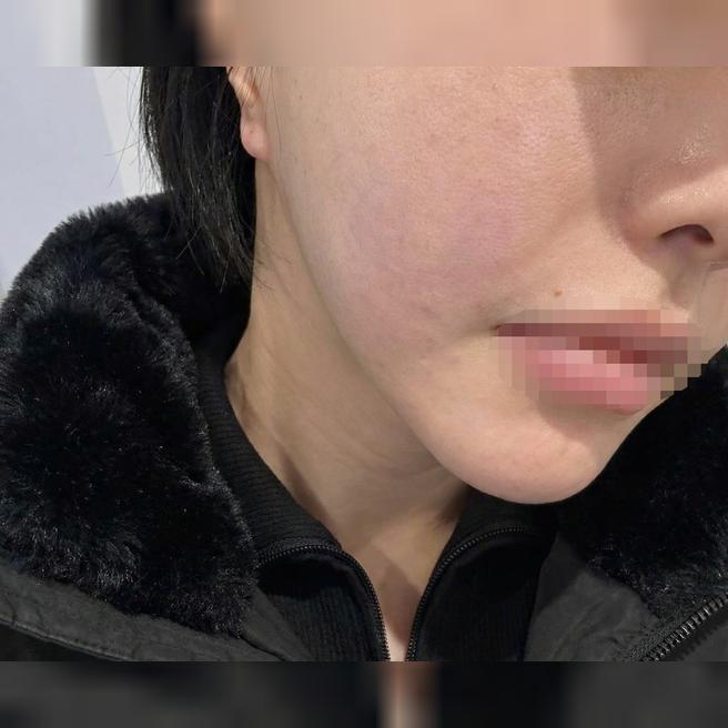 리쥬란 받았는데 엠보 균일하게 잘 생겨서 완전 대만족이에요!!