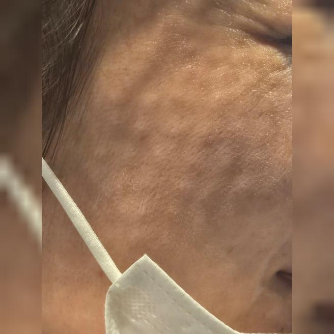 수분 채우려고 리쥬란 받아봤는데 시술이랑 응대 모두 만족이에요!!