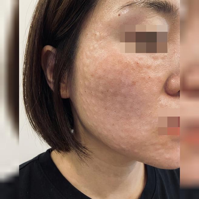 통증 없이 미친 광 피부! 주기적 리쥬란 강추드려요