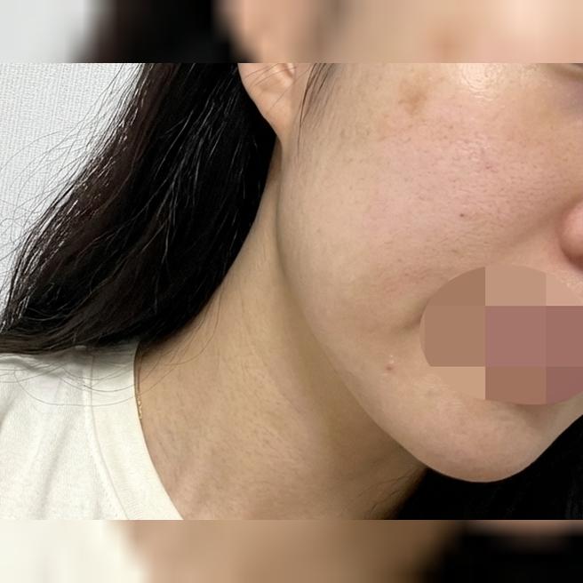 계절 상관없이 속건조 못 참아서 리쥬란 또 맞고 왔어요!!