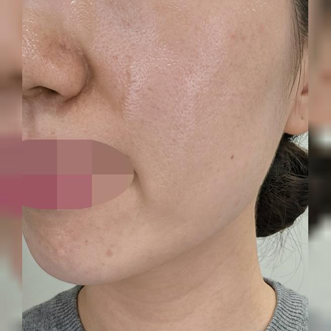 급격히 떨어진 피부 컨디션 고칠려고 쥬베룩 한번 받아봤어요~ㅎㅎ