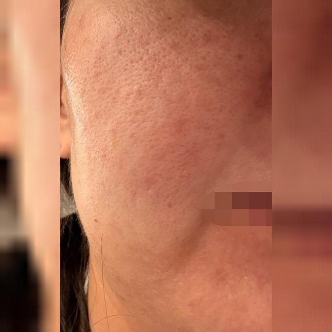 수면으로 진행해서 고통 하나 없이 편하게 받고 왔는데 진짜 만족스러워요ㅎ