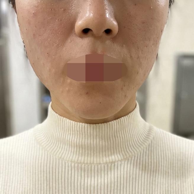 소문으로만 듣던 리쥬란 받으려고 방문했습니다ㅎㅎ