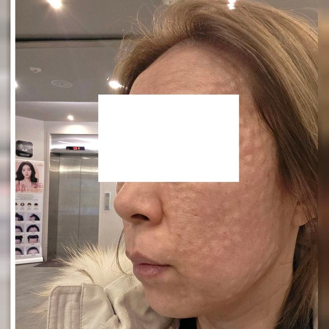 첫 방문인데 수면 마취 괜히 걱정했어요ㅎㅎ 촘촘하게 잘 해주셔서 만족~