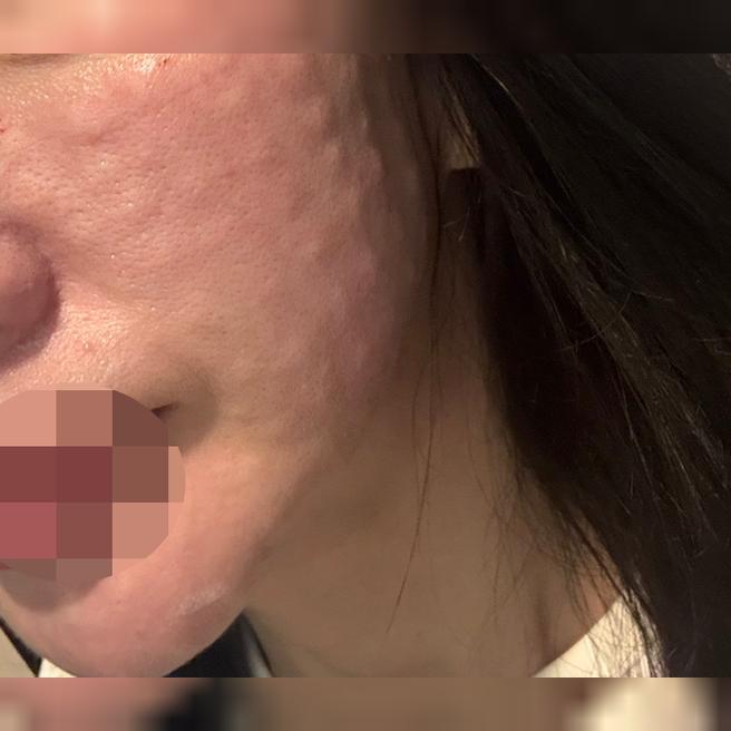 엠보 빵빵하게 잘 잡혀서 리쥬란 재방문했어요!!