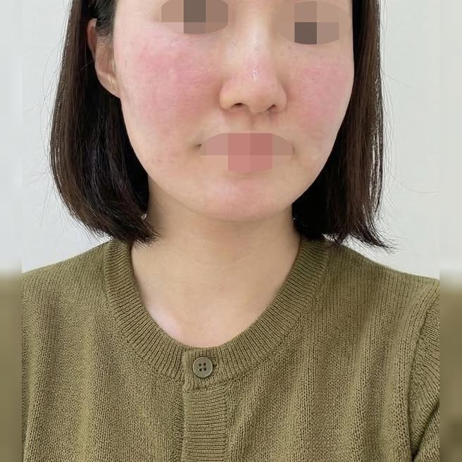 피부 관리 다시 시작하려고 리쥬란 받았어요~ 강남역에서 가까워서 너무 좋아요!