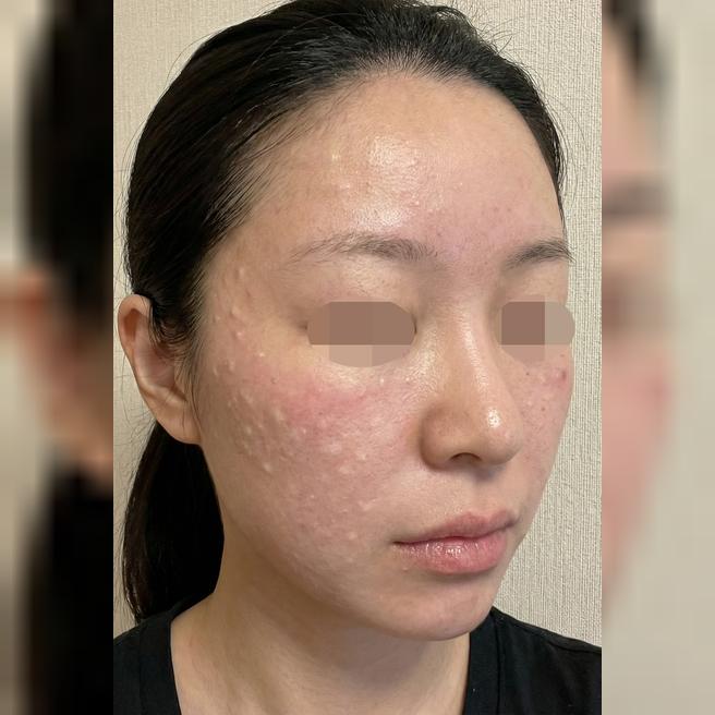 업셀링 없이 친절하게 상담해주셔서 좋았어요~ 3주 후 탄력 굿!!