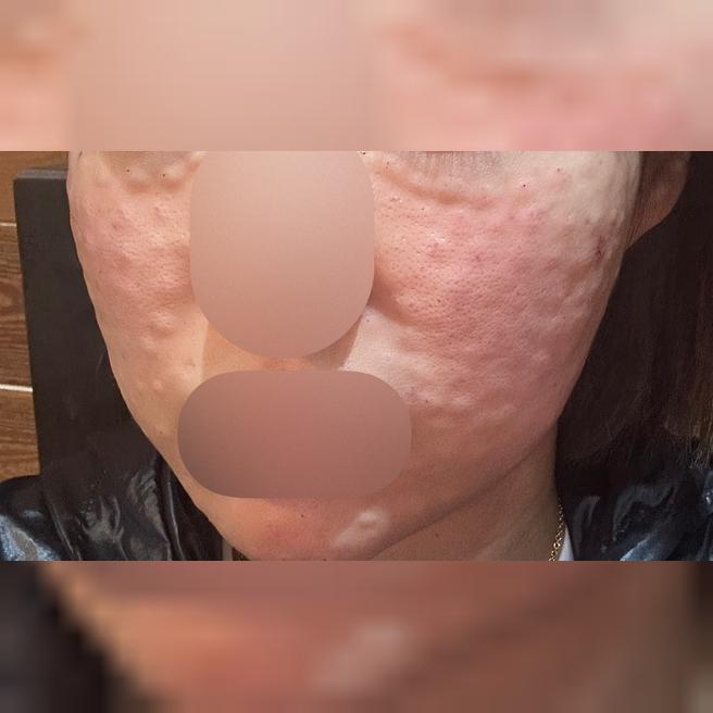 피부결 고민으로 리쥬란 받았는데 완전 대만족!