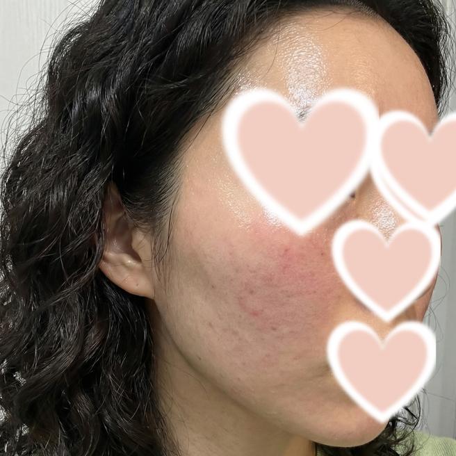 리쥬란 드디어 맞았어요, 당일 후기 남겨봐요