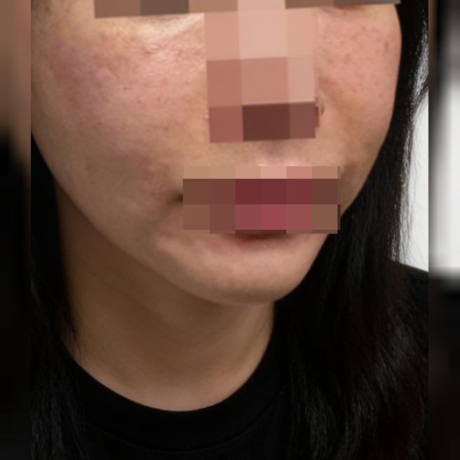 잔주름이랑 건조함 고민으로 리쥬란 받았는데 경과가 벌써 기대돼요