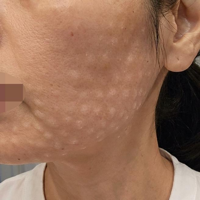 늘어진 피부랑 잔주름 고민, 꼼꼼한 시술로 케어 시작했어요.