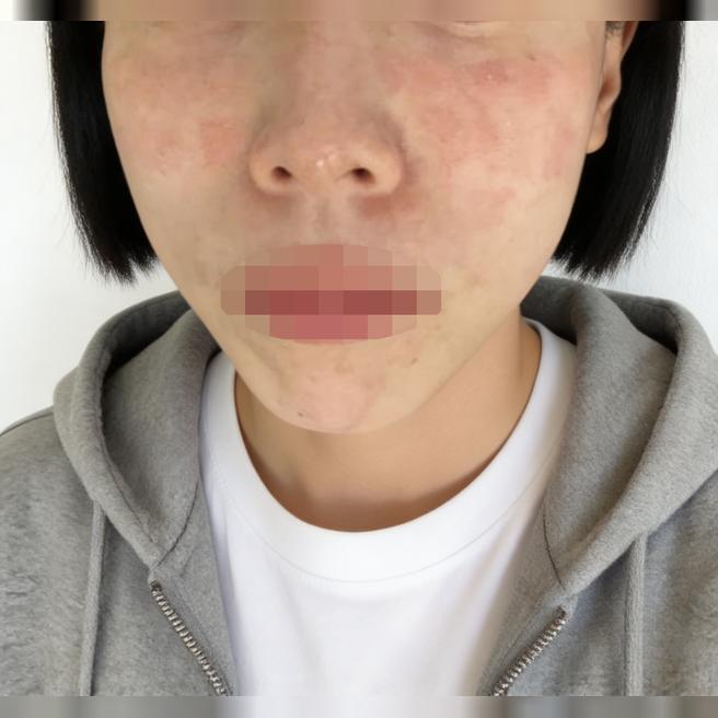모공이랑 탄력 고민으로 왔는데, 일본어 통역 스태프님으로 원활하게 원하는 거 진행돼서 좋았어요!