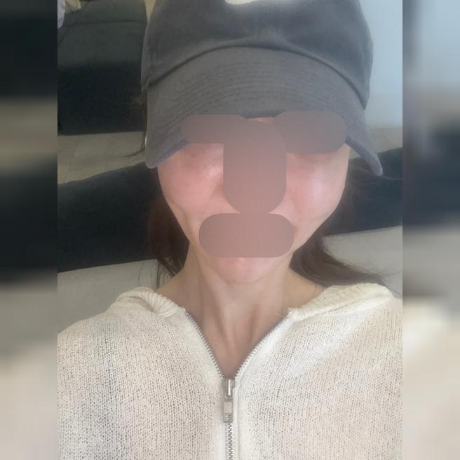 인모드 꾸준히 받으니 얼굴 라인 확실히 달라진 것 같아요